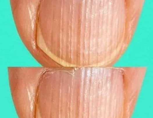 Having Striped Nails Could Mean That Your Body Is… Read More